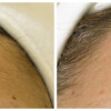 Hydrafacial results