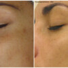 Hydrafacial results