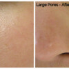 Hydrafacial results