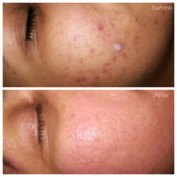 Microneedling results