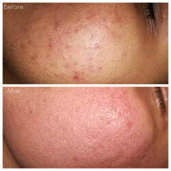 Microneedling results