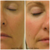 Hydrafacial results
