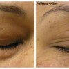 Hydrafacial results